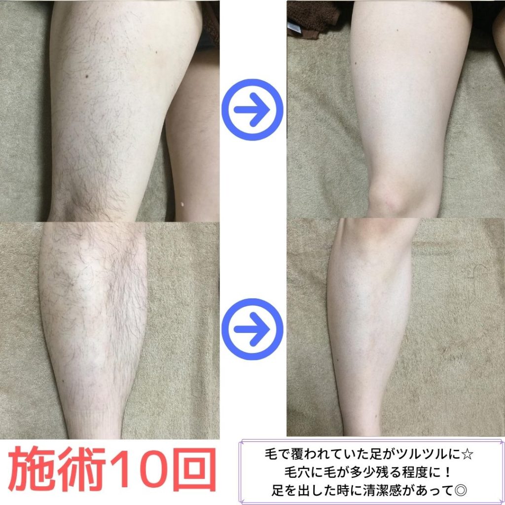 嘉瀬様　足　脱毛効果